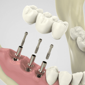 Reabilitação Oral: Implantes e Próteses